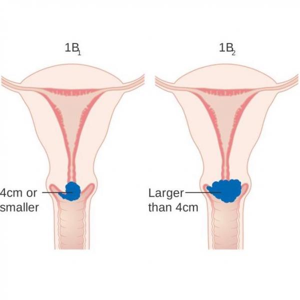 Colposcopy CancerQuest   IMG 0263 0 